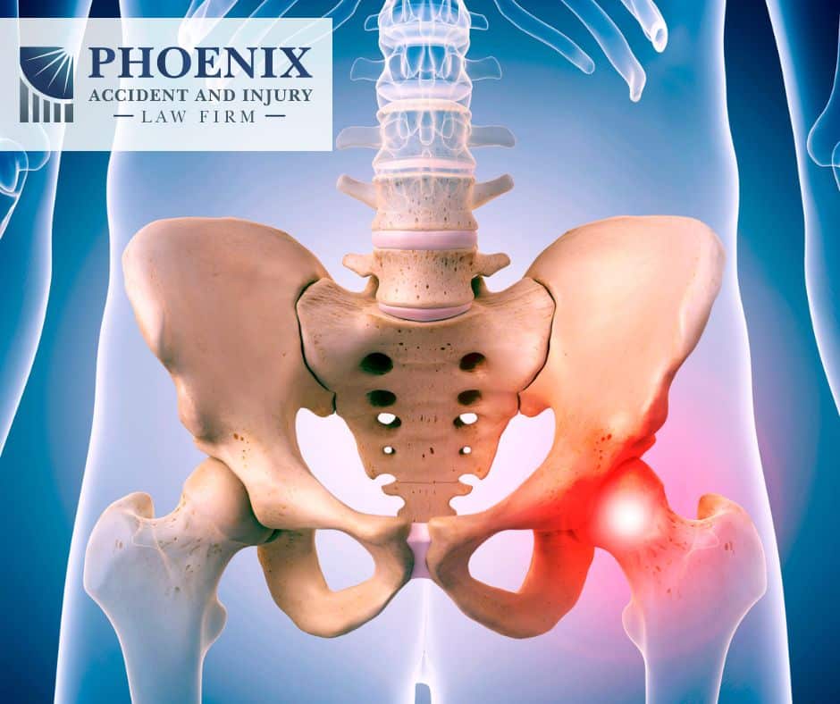 Copy of Arizona DePuy Hip lawyer class action lawsuit phoenix accident and injury law firm